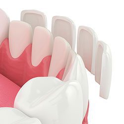 Veneers - Mark Michna, DDS