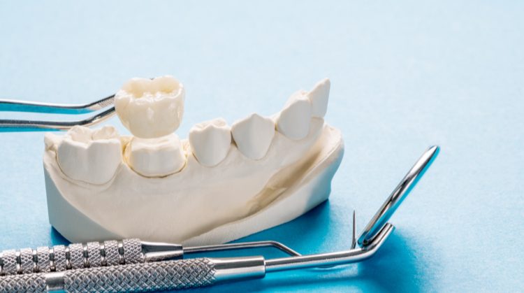 Dental crown model with tools at Mark Michna, DDA, Greenbrae, CA.