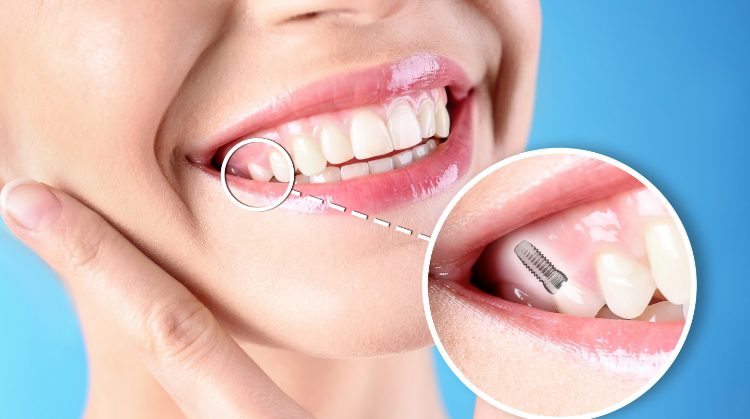 Close-up of a smiling woman with a dental implant illustration, highlighting tooth restoration by Mark Michna, DDS in Greenbrae, CA.