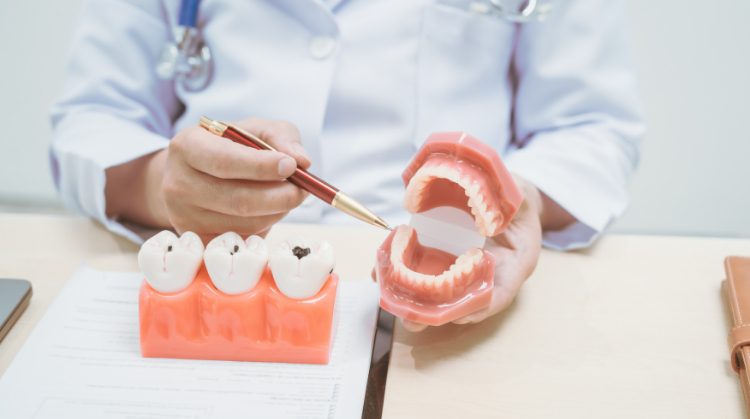 Dentist at Mark Michna, DDS in Greenbrae, CA explaining cavity prevention and treatment using tooth and jaw models.