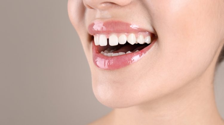 Close-up of a smiling woman showing gaps between her front teeth – Mark Michna, DDA, Greenbrae, CA