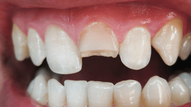Close-up of a chipped front tooth needing dental bonding.