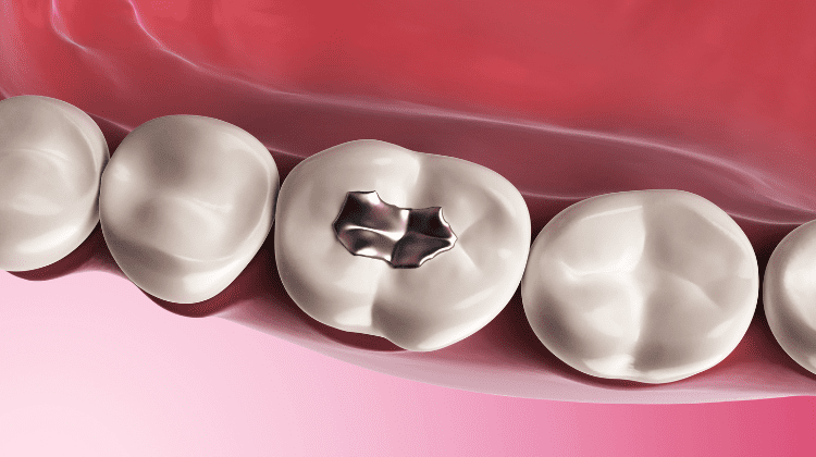 Molar tooth with a silver dental filling among natural teeth.