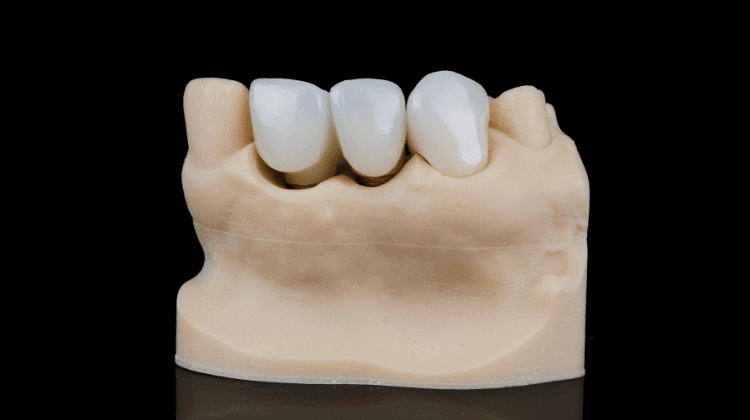 Dental model showing a bridge with three artificial teeth used to replace missing teeth.