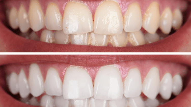Before and after image of professional teeth whitening at Mark Michna, DDS in Greenbrae, CA.